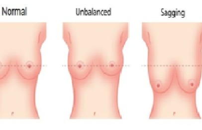 Breast Reduction